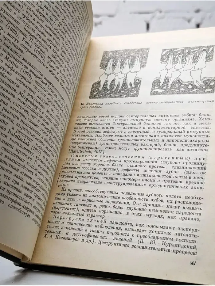 Заболевания пародонта