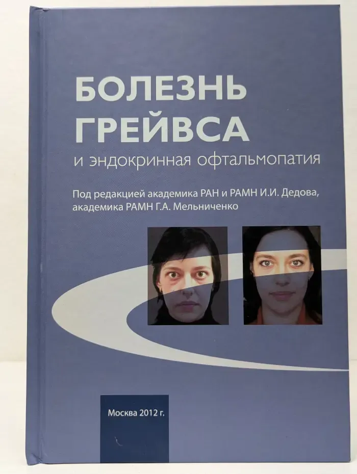 Болезнь Грейвса и эндокринная офтальмопатия