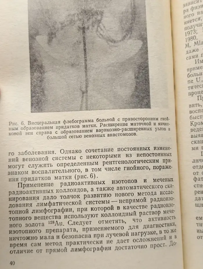 Хирургическое лечение придатков матки